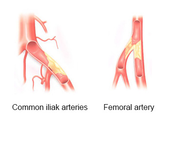 Arterial Diseases of Lower Extremity