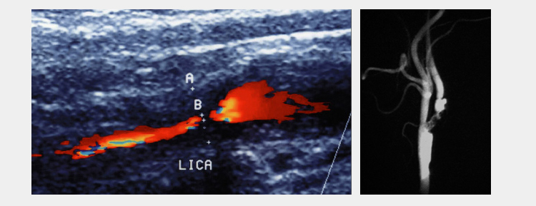 Carotid Aortal Diseases